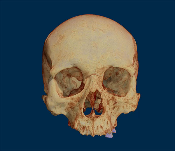 Neanderthal skull - Micro-CT 3D Scan
