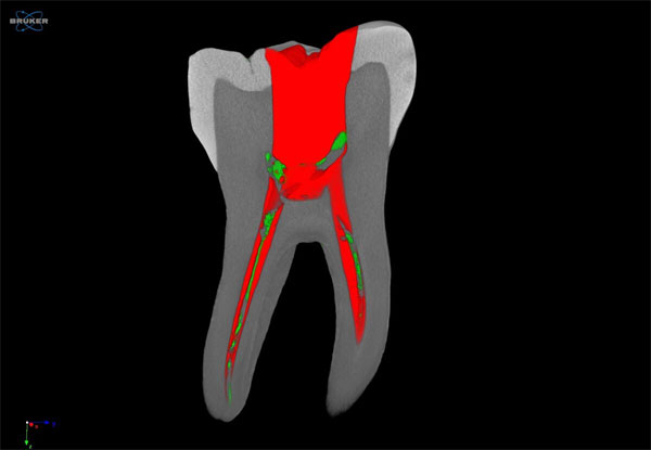 Root Canal Scan